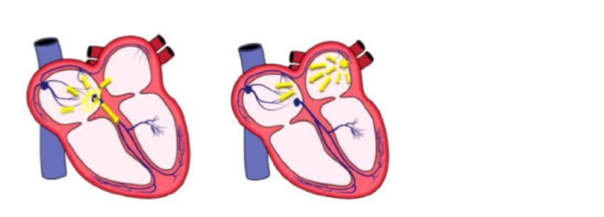 Κολποκοιλιακή ταχυκαρδία με επανείσοδο στον κολποκοιλιακό κόμβο