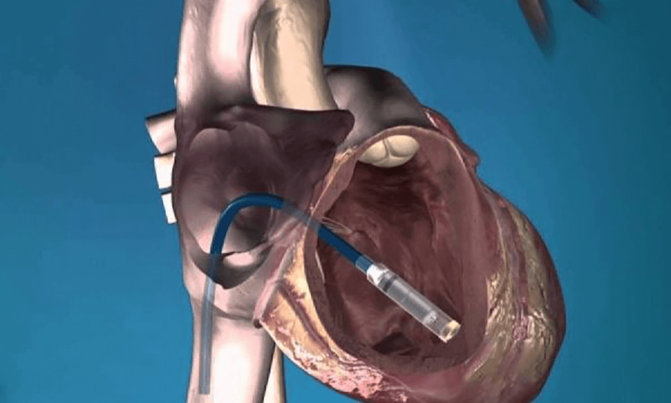 Βηματοδότης χωρίς καλώδια