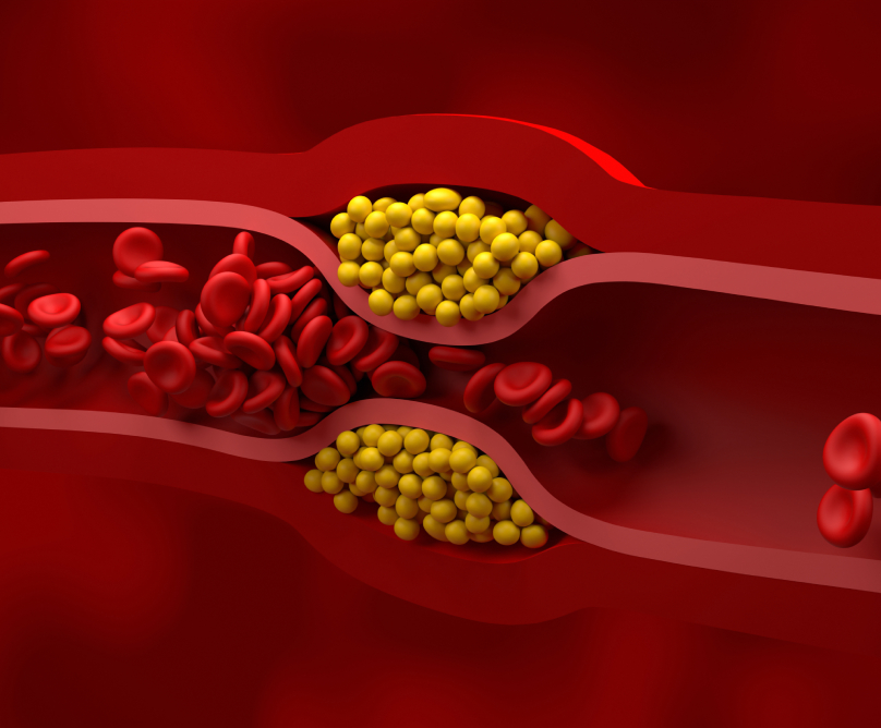 Υπερχοληστερολαιμία: ένας «ύπουλος» εχθρός