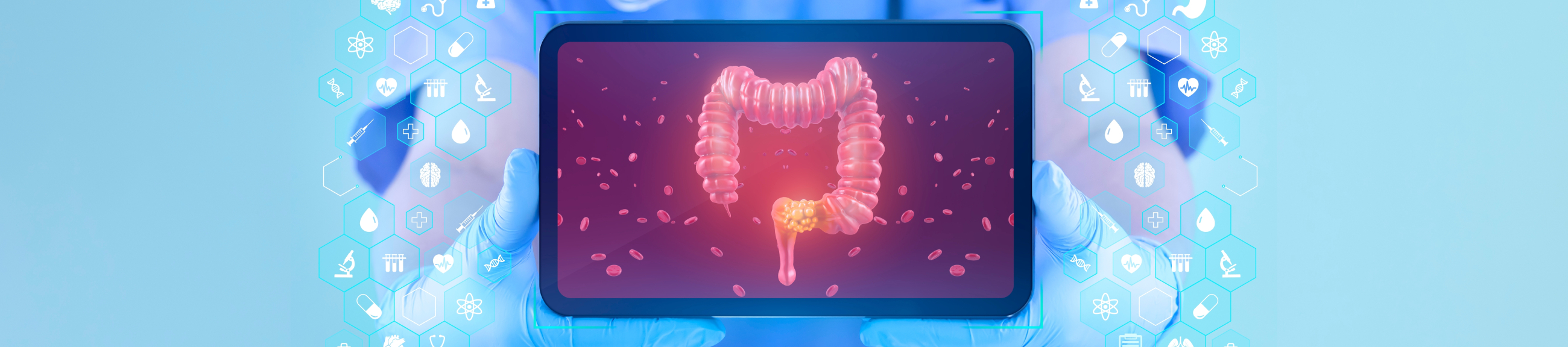 Ο καρκίνος του παχέος εντέρου και η θεραπευτική του αντιμετώπιση