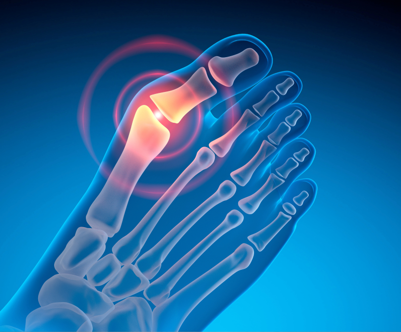 Βλαισός Μέγας Δάκτυλος (Κότσι): αιτίες και θεραπείες