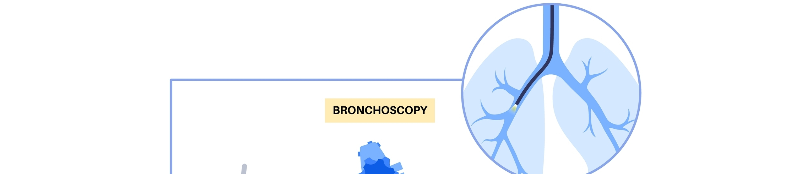 Βρογχοσκόπηση: μια κλασική διαγνωστική μέθοδος απλή, ευρείας εφαρμογής και πάντα αποτελεσματική