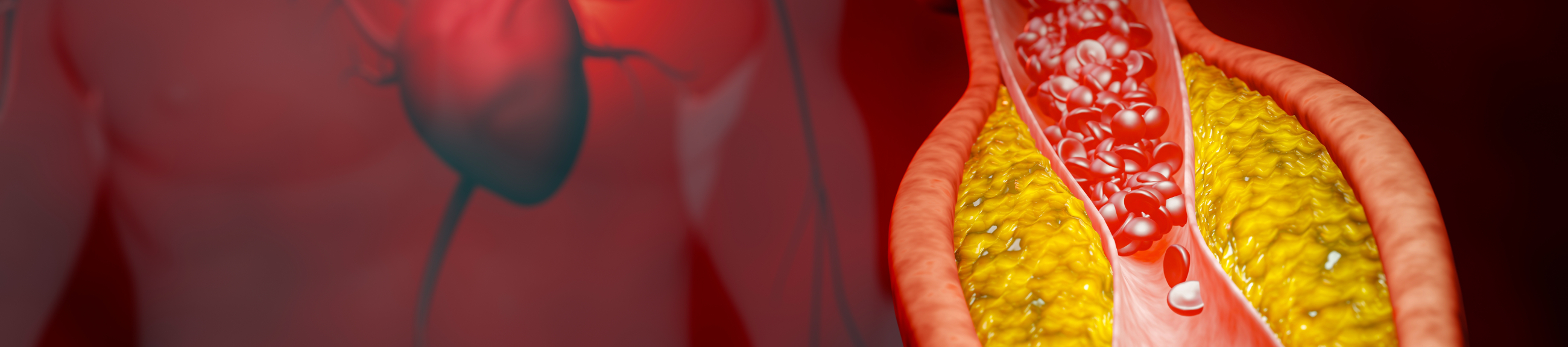 Ενδοστεφανιαία λιθοτριψία