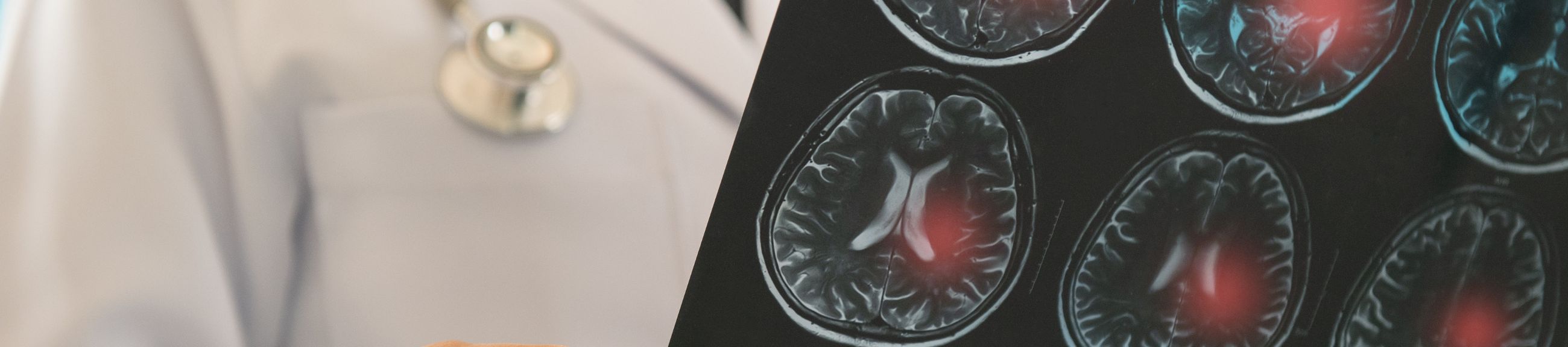 Ισχαιμικό εγκεφαλικό