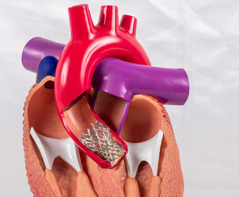 Αντικατάσταση αορτικής βαλβίδας (TAVI) χωρίς διάνοιξη του θώρακα