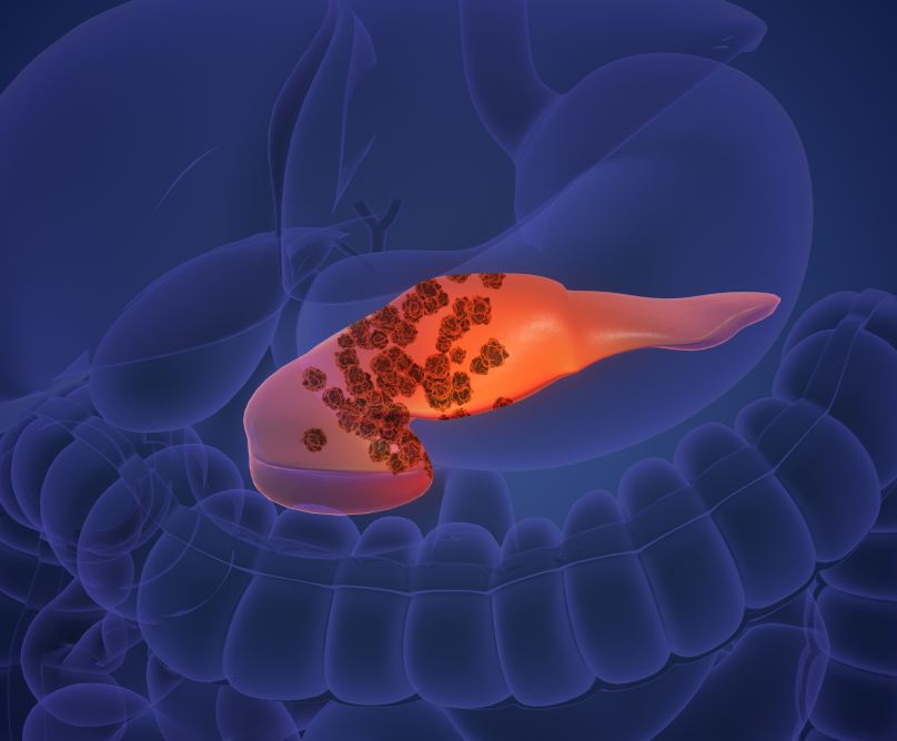 Παγκόσμια Ημέρα του Καρκίνου του Παγκρέατος