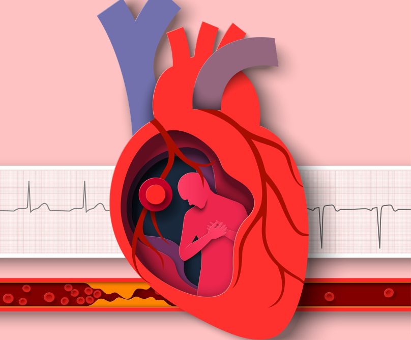 Οξεία μυοκαρδίτιδα 